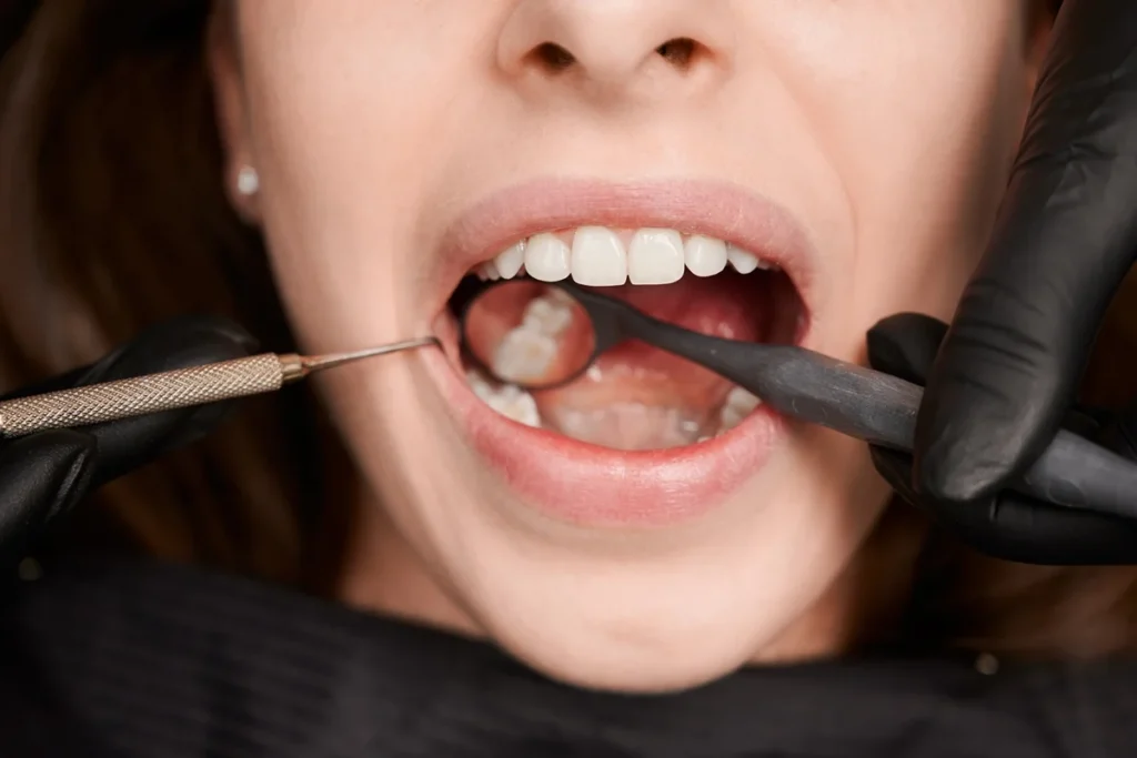 Gel sem flúor regenera esmalte dental danificado por cárie