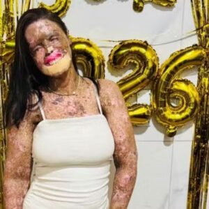 Influenciadora Káh Felipe morre aos 31 anos após luta contra xeroderma pigmentoso e câncer